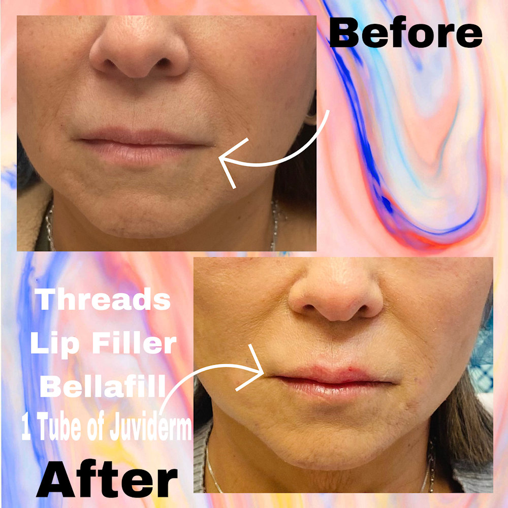 PDO Thread Lift of the jowls, before and after
